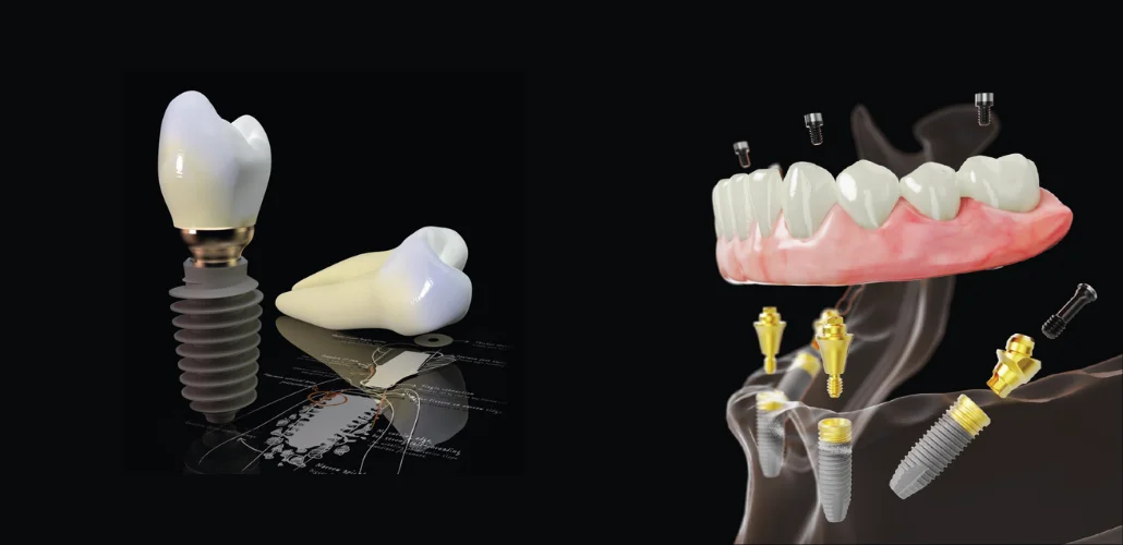 Preco-de-Implante-Dentario - Dr. Mauro Lino