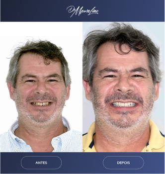 antes-e-depos-04.webp